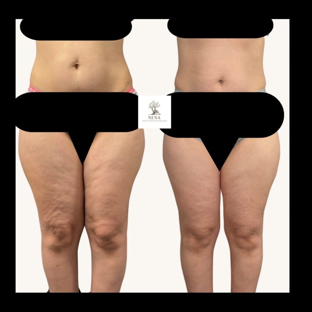Customized body sculpting and cellulite reduction at Nena Weight Loss Center and Spa